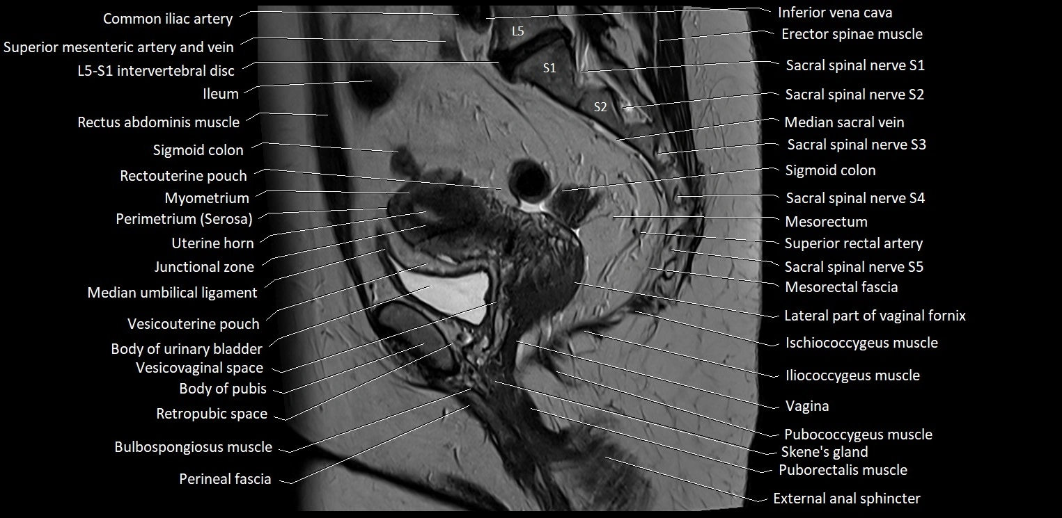 Sagittal cross sectional anatomy of female pelvis (MRI 3T) image 18.webp